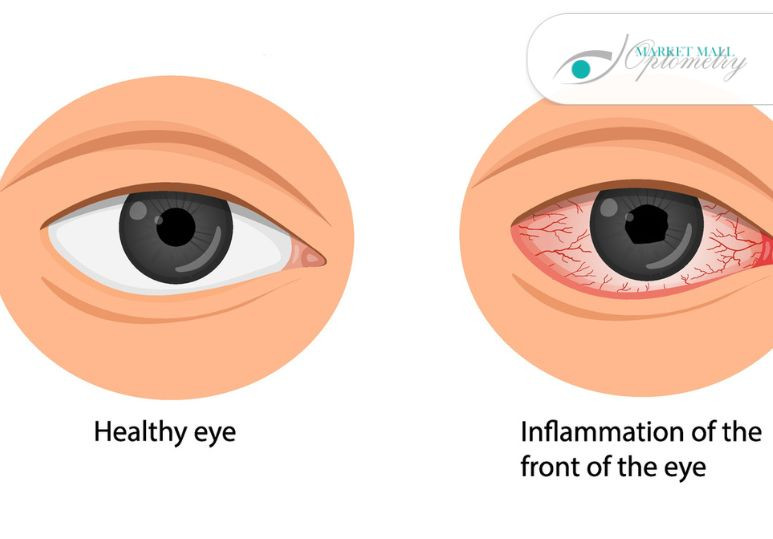 Understanding Uveitis: Types, Causes, and Symptoms